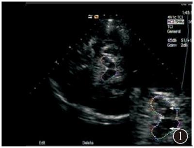 Application and progress of transcranial substantial ultrasound in Parkinson's disease